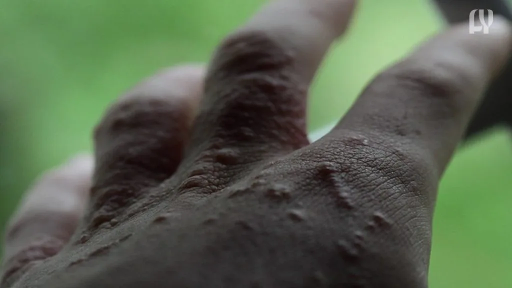 Hammanskraal Schoolgirl Suspected of Mpox Case Tested Negative, Says Health Department