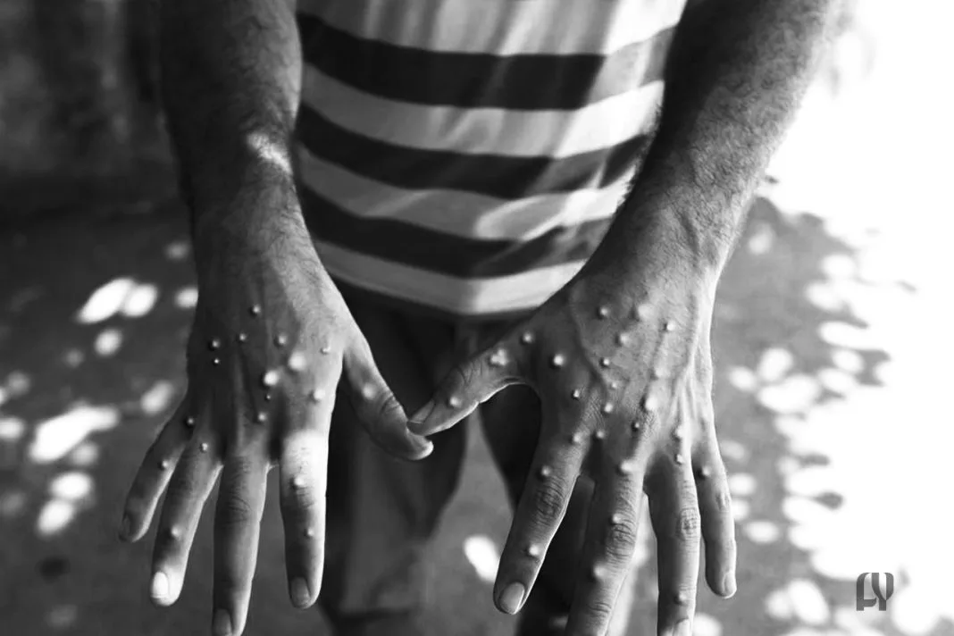 Hammanskraal Schoolgirl Suspected of Mpox Case Tested Negative, Says Health Department